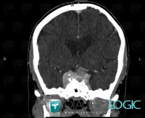 Meningioma, Pituitary gland and parasellar region, CT