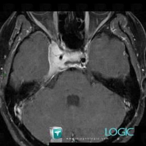 Meningioma, Pituitary gland and parasellar region, MRI