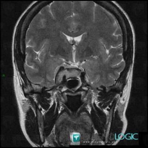 Meningioma, Pituitary gland and parasellar region, MRI