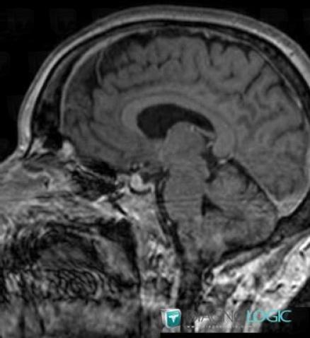 Meningioma, Pituitary gland and parasellar region, MRI