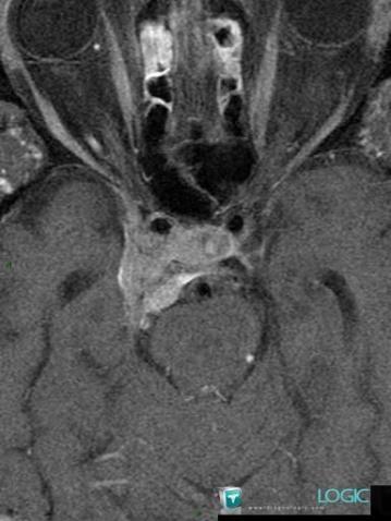 Meningioma, Pituitary gland and parasellar region, MRI