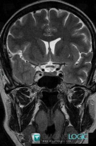 Meningioma, Pituitary gland and parasellar region, MRI