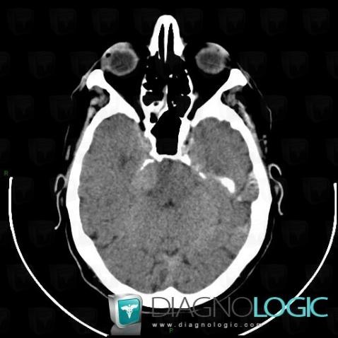 Meningioma, Posterior fossa, CT