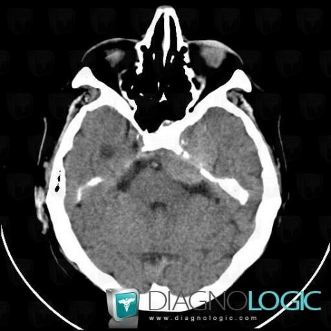 Meningioma, Posterior fossa, CT