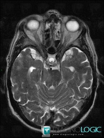 Meningioma, Posterior fossa, MRI