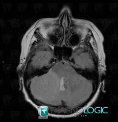 Meningioma, Posterior fossa, MRI