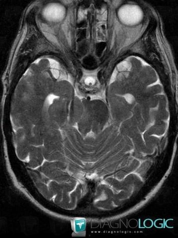 Meningioma, Posterior fossa, MRI