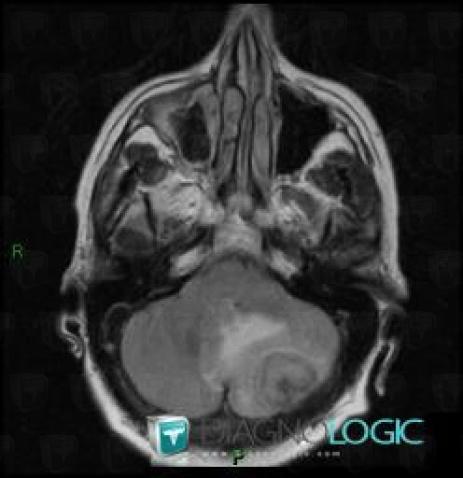 Meningioma, Posterior fossa, MRI
