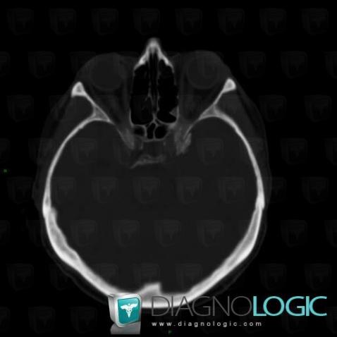 Meningioma, Skull vault, CT