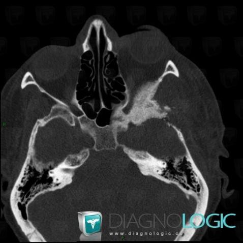 Meningioma, Skull vault, CT