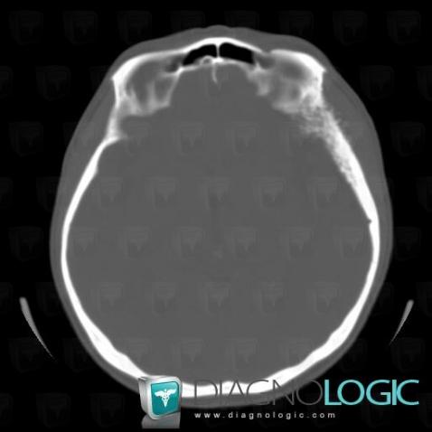 Meningioma, Skull vault, CT