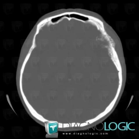 Meningioma, Skull vault, CT