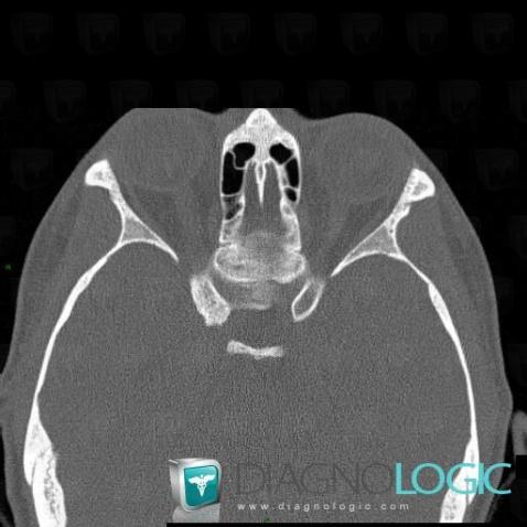 Meningioma, Skull vault, Sphenoid bone, CT