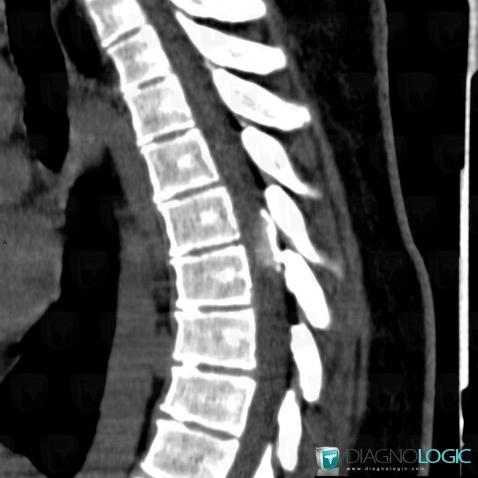 Meningioma, Spinal canal / Cord, CT