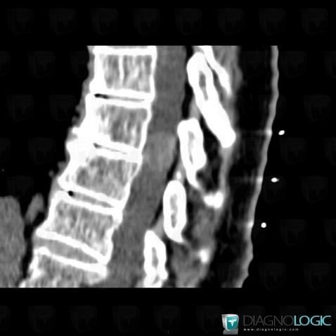 Meningioma, Spinal canal / Cord, CT