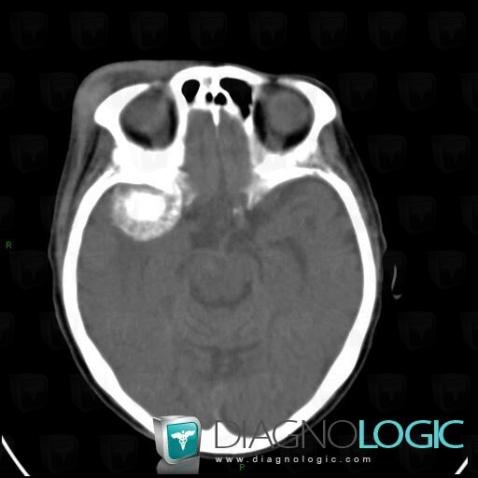 Meningioma, Supratentorial peri cerebral spaces, Cerebral hemispheres, CT