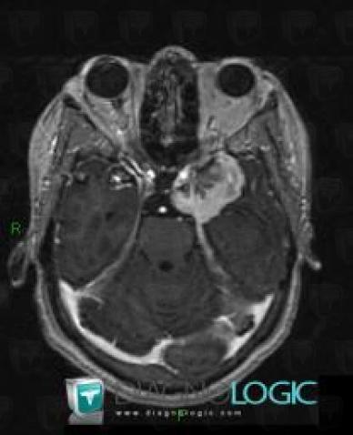 Meningioma, Supratentorial peri cerebral spaces, Cerebral hemispheres, MRI