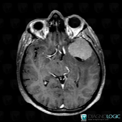 Meningioma, Supratentorial peri cerebral spaces, Cerebral hemispheres, MRI