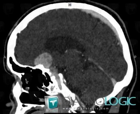 Meningioma, Supratentorial peri cerebral spaces, CT