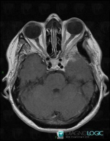 Meningioma, Supratentorial peri cerebral spaces, MRI