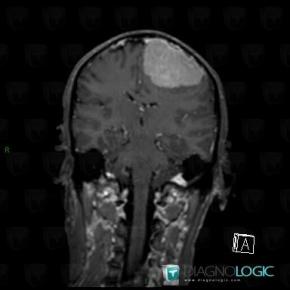 Meningioma, Supratentorial peri cerebral spaces, MRI