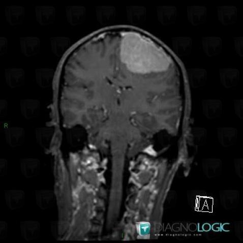 Meningioma, Supratentorial peri cerebral spaces, MRI