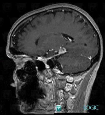 Meningioma, Supratentorial peri cerebral spaces, MRI