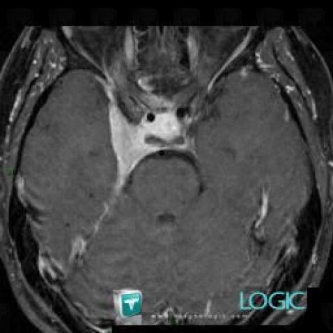 Meningioma, Supratentorial peri cerebral spaces, MRI