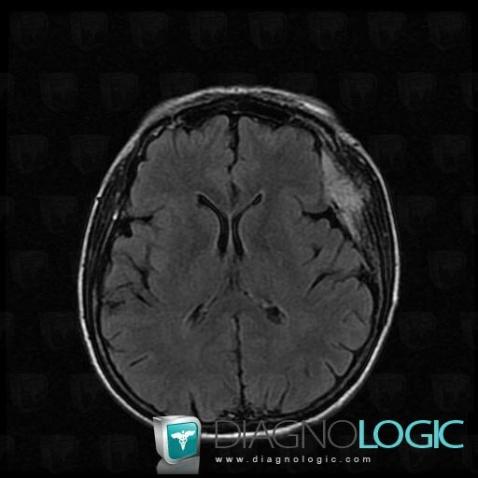 Meningioma, Supratentorial peri cerebral spaces, MRI