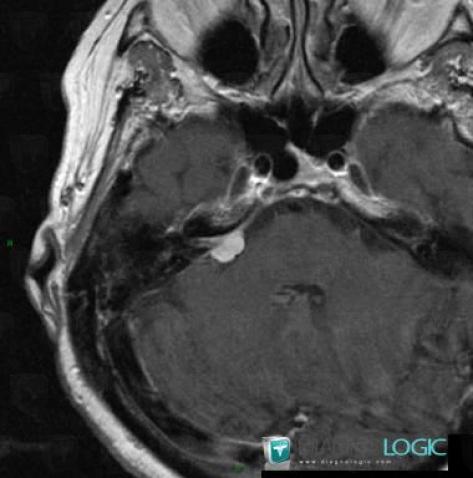 Méningiome , Angle ponto cérébelleux, Nerfs VII VIII, IRM