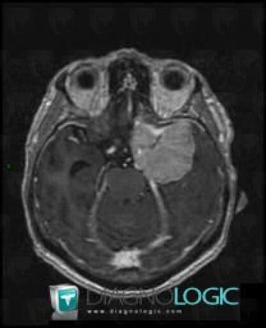 Méningiome , Espaces peri cérébraux supratentoriels, Hémisphères cérébraux, IRM