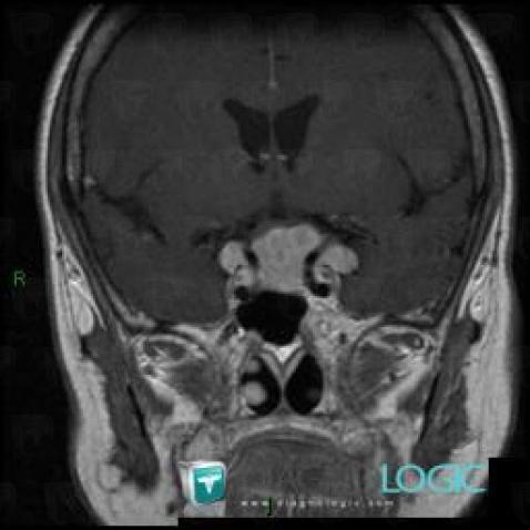 Méningiome , Faux-cerveau / Ligne médiane, Hypophyse et région parasellaire, IRM