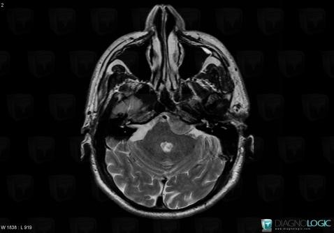 Méningiome , Fosse postérieure, IRM