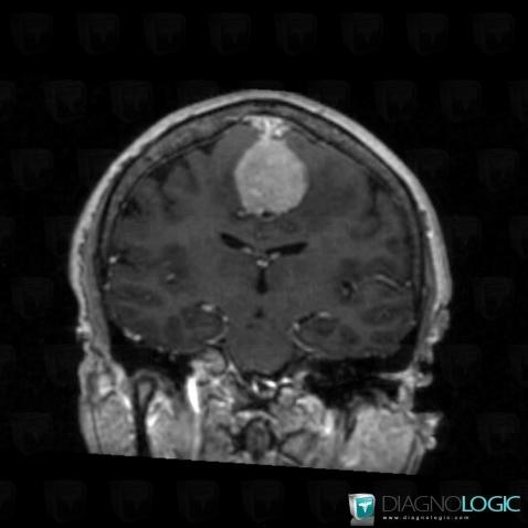Méningiome , Hémisphères cérébraux, Faux-cerveau / Ligne médiane, IRM