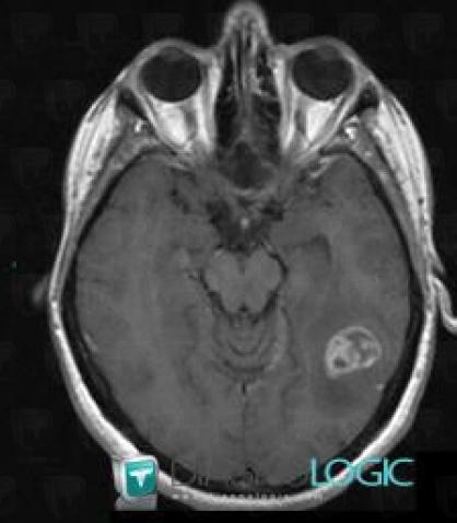 Méningiome , Hémisphères cérébraux, IRM