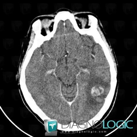 Méningiome , Hémisphères cérébraux, Scanner