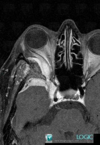 Méningiome , OEil, IRM