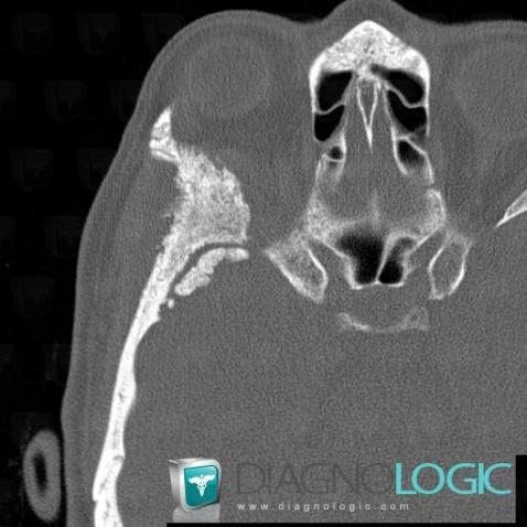 Méningiome , Voute-crâne, Os-l orbite, Scanner
