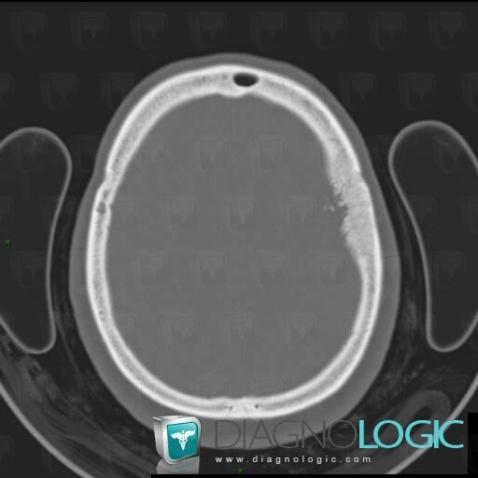 Méningiome , Voute-crâne, Scanner