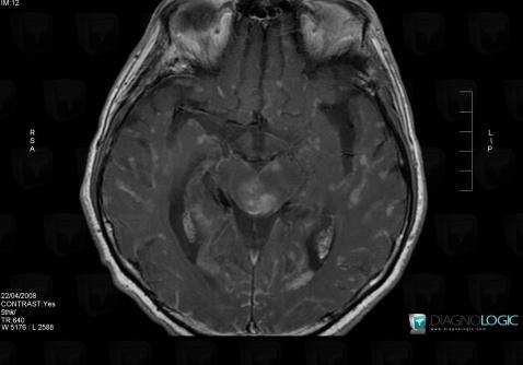 Méningite carcinomateuse, Région cortico sous corticale, IRM