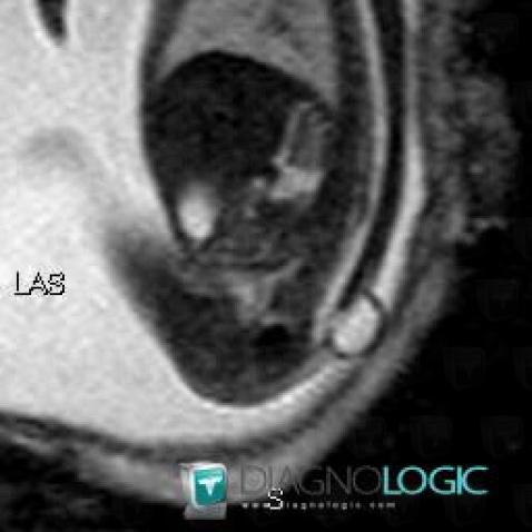 Meningocele, Vertebral body / Disk, Spinal canal / Cord, MRI