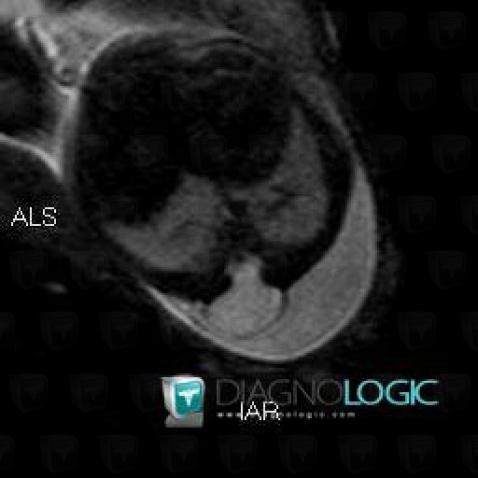 Meningocele, Vertebral body / Disk, Spinal canal / Cord, MRI