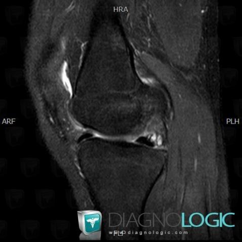 Meniscal cyst, Femorotibial joints - Intercondylar notch, Other soft tissues/nerves - Knee, MRI