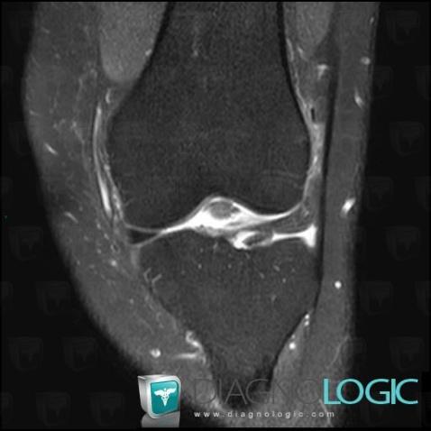 Meniscal flap tear, Meniscus, MRI