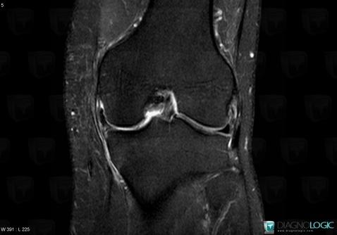 Meniscal flap tear, Meniscus, MRI