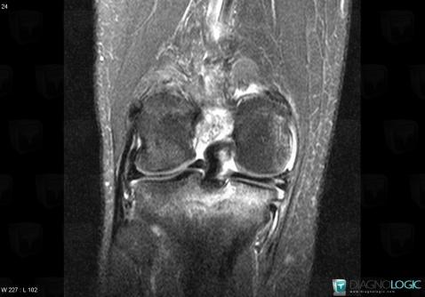 Meniscal flap tear, Meniscus, MRI