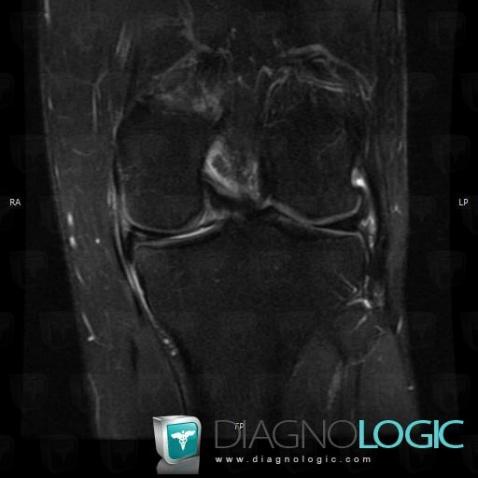 Radiology case : Meniscal flap tear (MRI) - Diagnologic