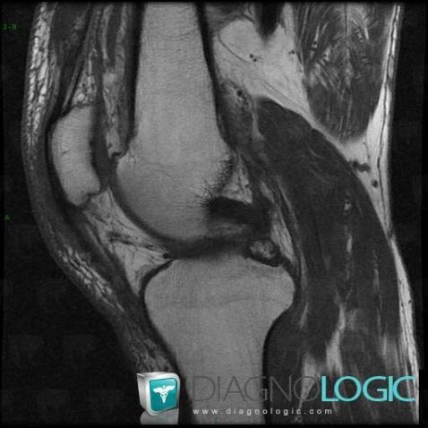 Meniscal ossicle, Femorotibial joints - Intercondylar notch, Meniscus, MRI