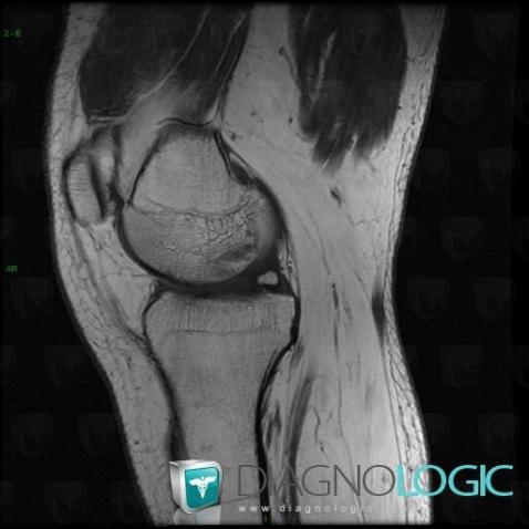 Meniscal ossicle, Femorotibial joints - Intercondylar notch, Meniscus, MRI