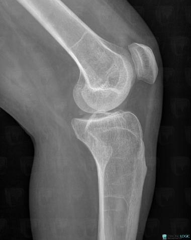 Meniscal ossicle, Femorotibial joints - Intercondylar notch, X rays